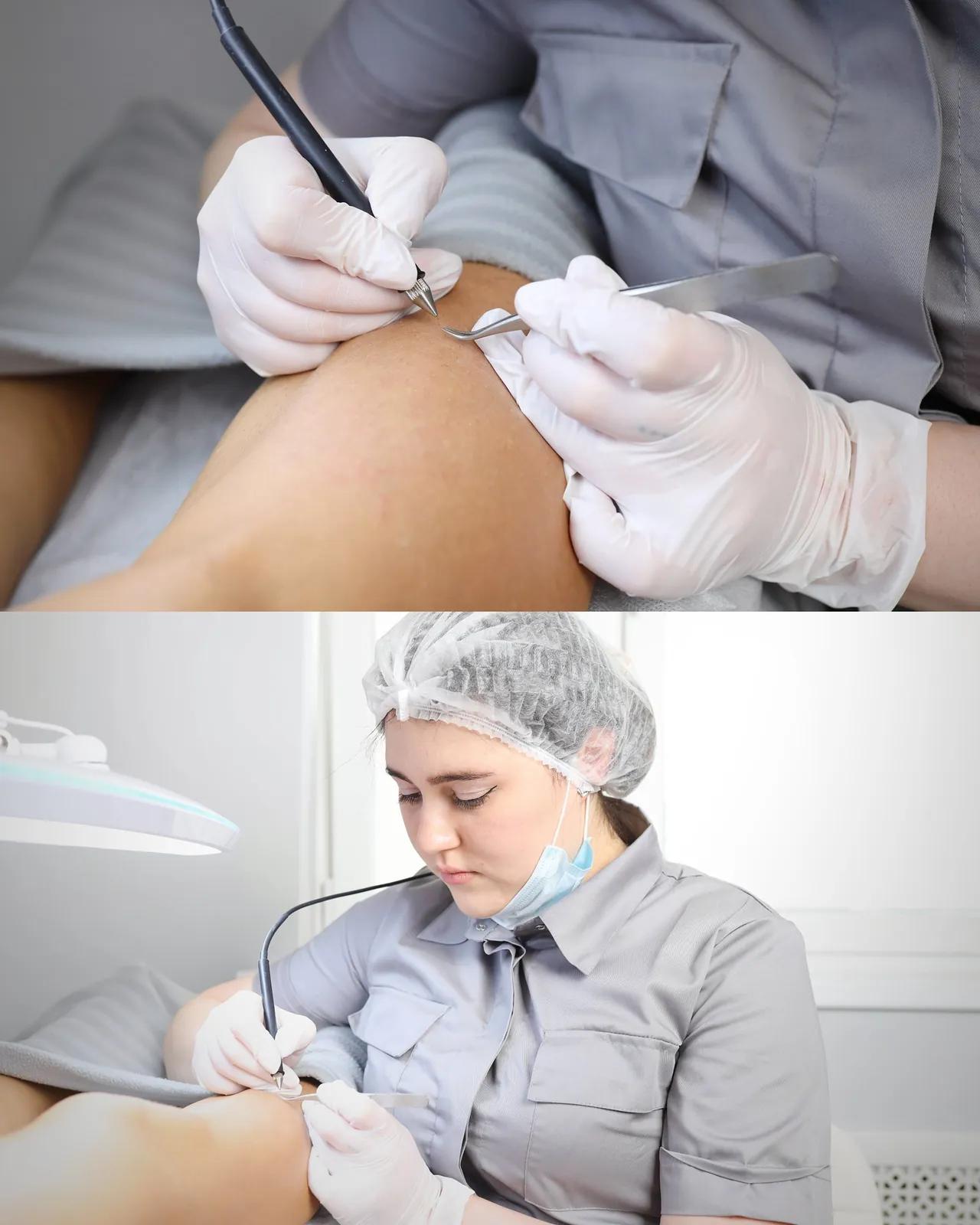 Электроэпиляция в Белграде и Нови-Саде