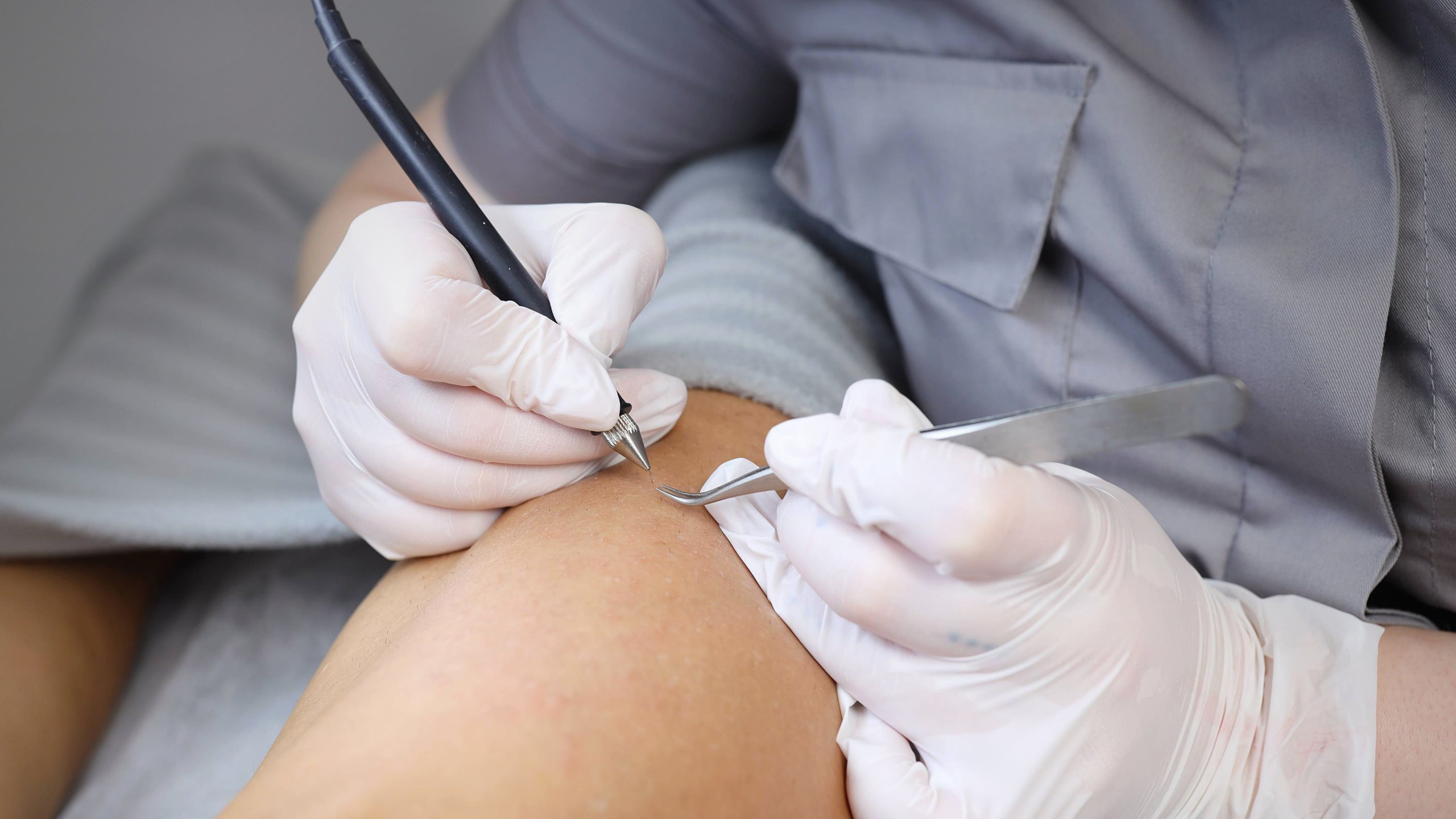 Электроэпиляция 1